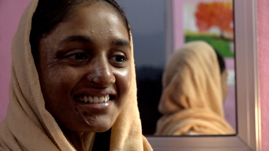 एसिड पीडित मुस्कान खातुनलाई प्रदेश २ सरकारले थप उपचारको लागि पुन: ५ लाख दिने